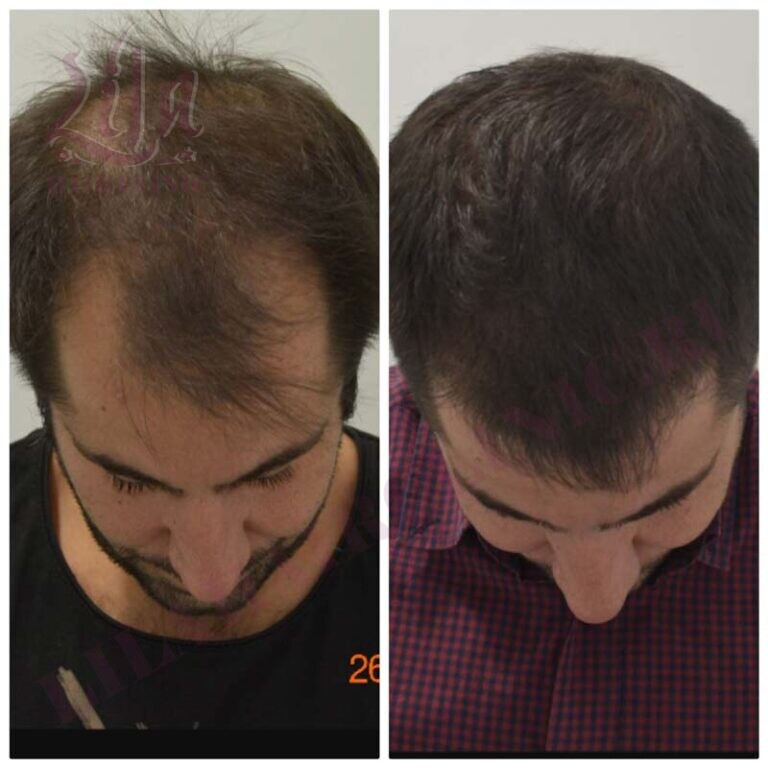 Турецкая пересадка волос