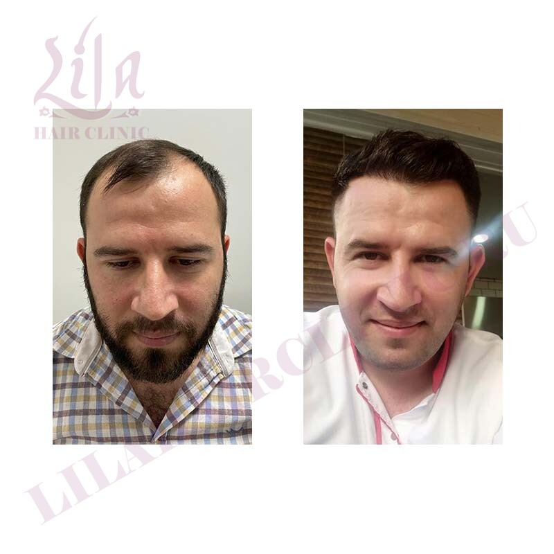 Пересадка волос до и после у мужчин реальные фото